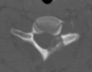 Osteoblastoma Spine0002